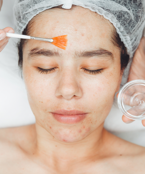 Facials for Acne